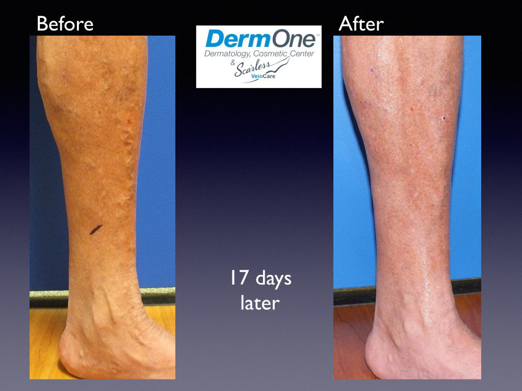 DermOne-Scarless-Vein-Care-Before-and-After.121 - Scarless 