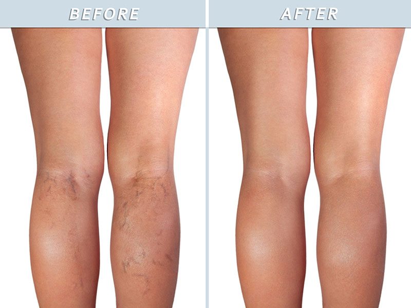 Before & After Varicose veins