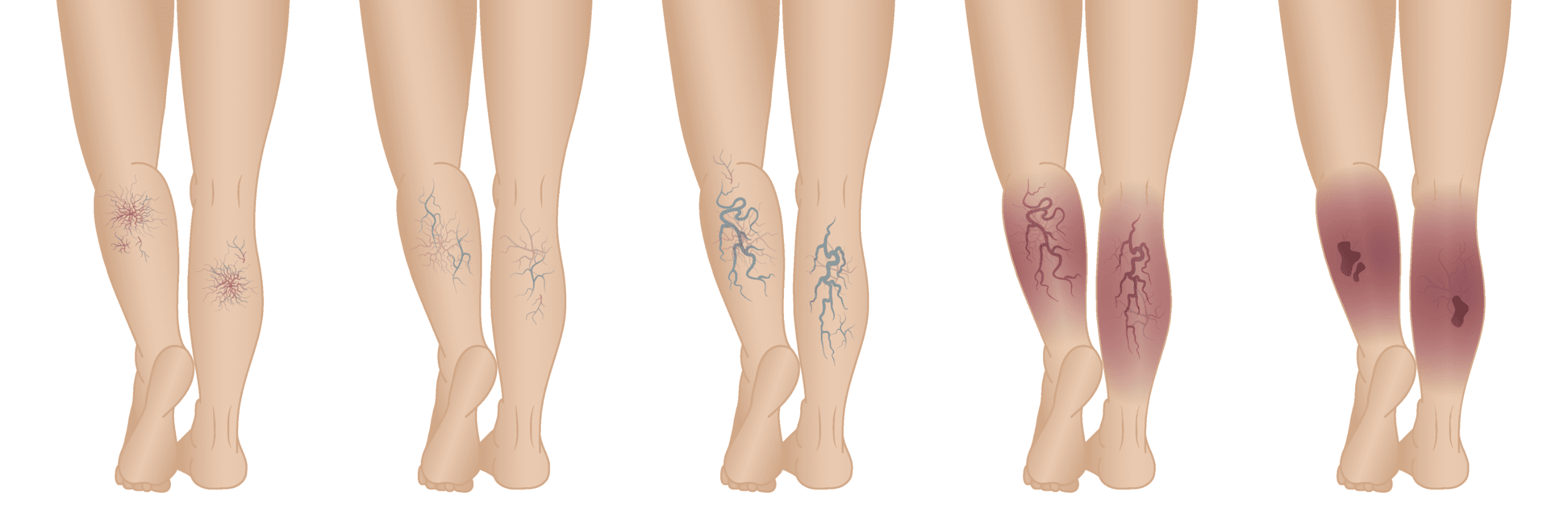 Stages of Venous Insufficiency - Scarless Vein Care