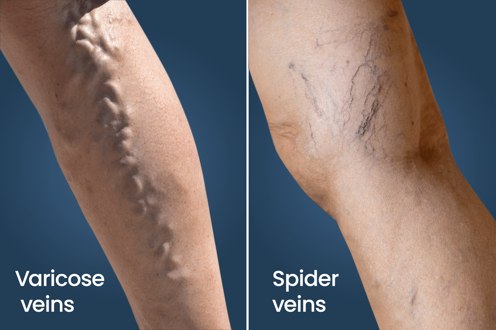 varicoseandspiderveins